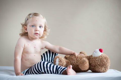 A toddler with varicella (Chicken Pox).