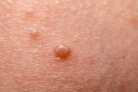 Small red bumps on skin or water warts, close view.