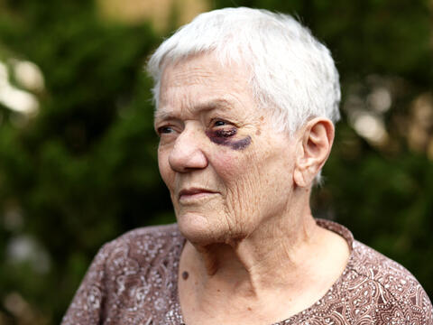 Close up of an older adult with a black eye