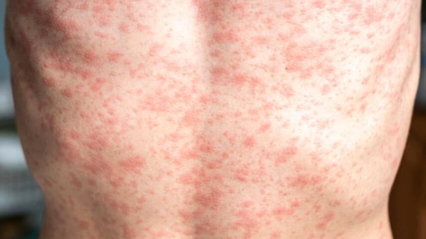 Close up of measles rash on back